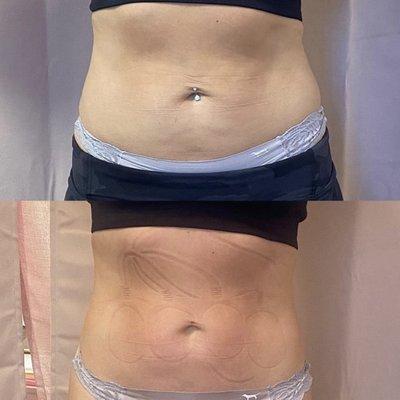 Body contouring treatment. 1 session.