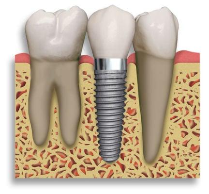 Dental implants are a great way to replace areas with missing teeth.