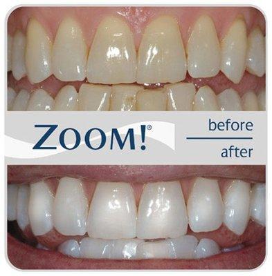 Original Zoom! In-office Whitening!
 Call us (424) 297-0513