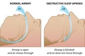 We can help you with Obstructive Sleep Apnea and/or snoring if you can not tolerate your CPAP!