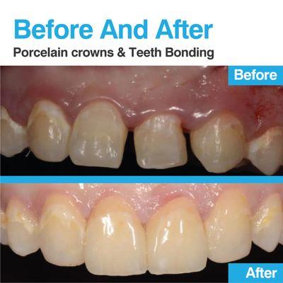 CASE #10: PORCELAIN CROWNS & TEETH BONDING  Would you like to schedule an appointment? Contact us and we will advise you:

(561) 279-699