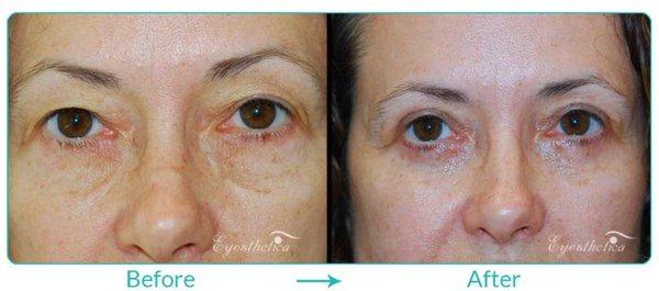 Before and After: Upper Blepharoplasty (Eyelid Lift) by Dr. Steven C. Dresner