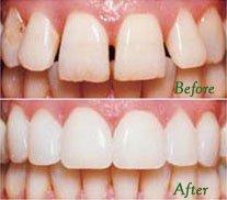 Porcelain veneers are amazing!