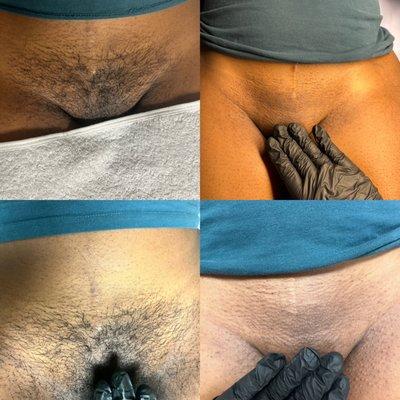 Before and after of a Brazilian wax.