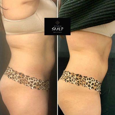 First-time mommy wanted to tighten her stomach and back area. Results after 8 sessions.