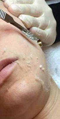 Dermaplaning