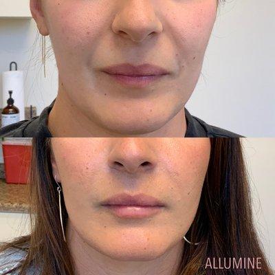 Smile line and lip filler