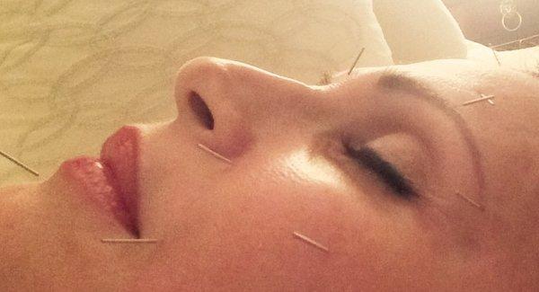 Facial Acupuncture