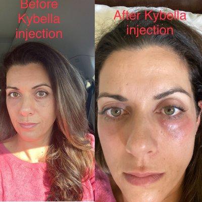 picture on left is the lump that formed post fat grafting procedure. Picture on right is after the Kybella injection (entire under eye)