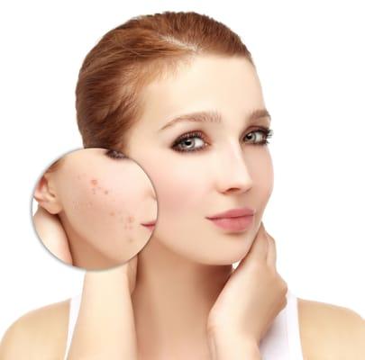 Clear Cell Acne Facial
 Fights Acne, Inflammation, Eliminates Excess Oil and Purifies Skin