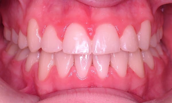 Wang Orthodontic Patient "A" After