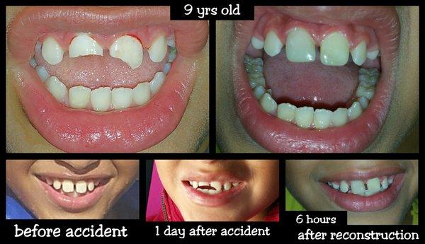 Incredible restoration done by Dr. Perez on one of our young patients