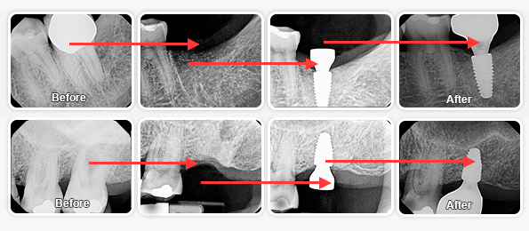 dental implants