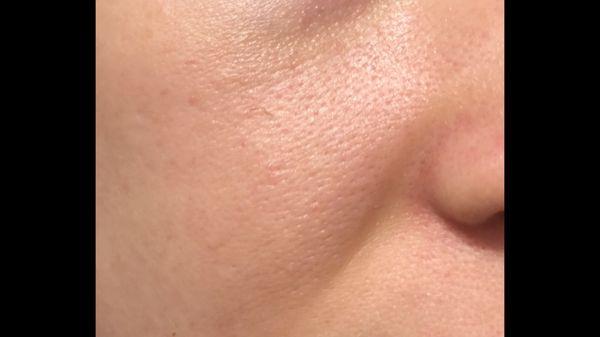 Skin damage and inflammation after chemical peel.