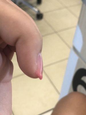 This is my dented nail. All of my nails look like this.