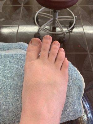 Bad job of a pedicure