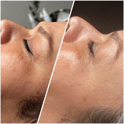 Before and after Face Lift/ Firming Facial