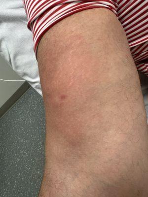 Superficial blood clot in right arm.