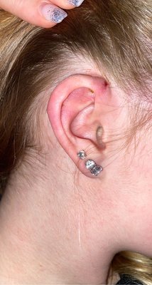 Immediately after piercing removal (2)