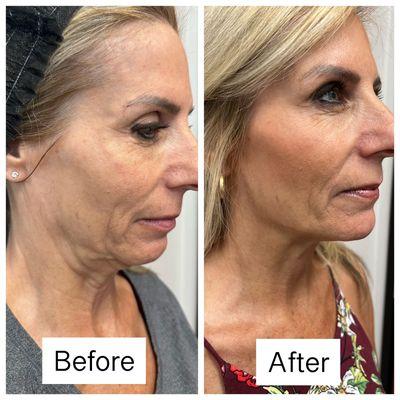 JUVEDERM VOLUX AND VOLUMA jawline, cheeks and chin dermal filler with Ageless Health Institute 602-680-7703