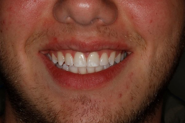 Invisalign after 11 months of treatment