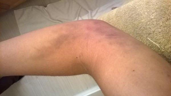 bruising.