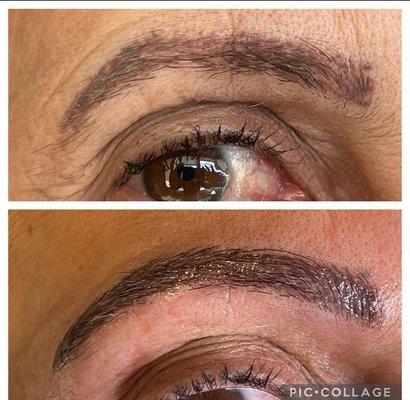 Upper eyelid lift