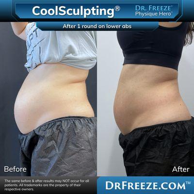 Dr. Freeze CoolSculpting Center