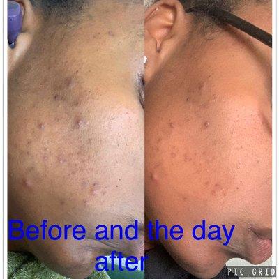 Microneedling Treatment