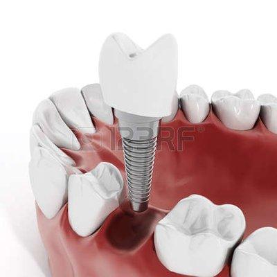 We specialize in Dental Implants