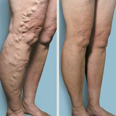 Before and after: varicose vein removal results. We offer a variety of varicose vein treatments, done in under 15 minutes!