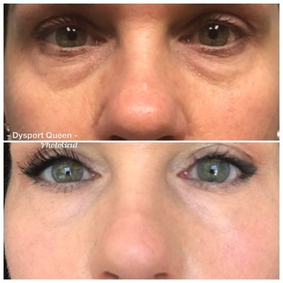 Tightening of under eyes using Plasma Pen