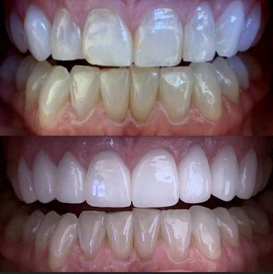 Veneers Before & After