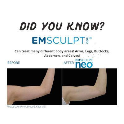 We can treat fat on the arms and build the biceps and tricep muscles as well!