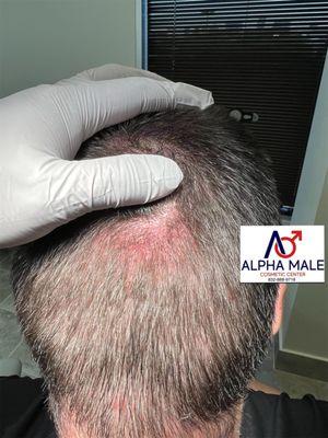 Not able to see scar now- after scalp micropigmentation