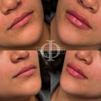 Before and After Lip filler