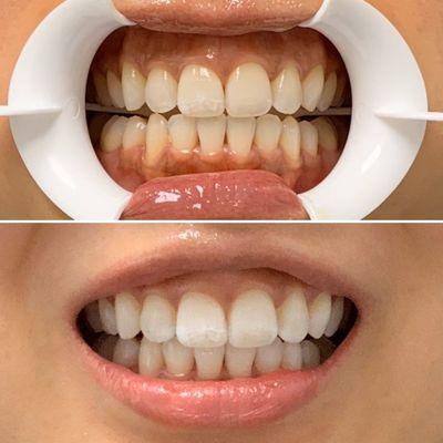 One hour in office whitening