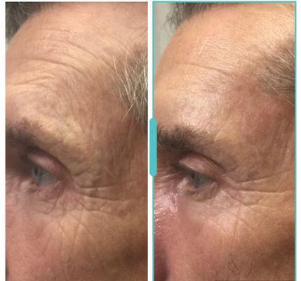 ONE TREATMENT RESULTS!