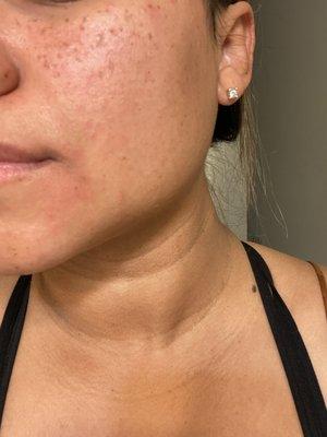 My skin super bumpy and red after the facial