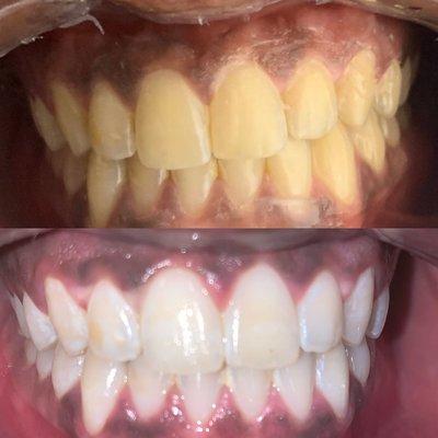 Signature Teeth Whitening Results (after 2 sessions)