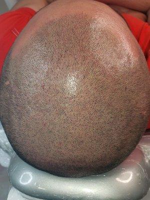 SCALP MICROPIGMENTATION NATURAL RESULTS ! HAIRLINE RESTORED ON THIS GENTLEMAN!