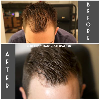 Hair restoration worked for me! So Happy!