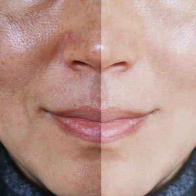 Chemical peel before and after