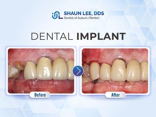 Shaun Lee, DDS Family Emergency Dental Implants of Auburn | 1320 8th St NE Ste. 103, Auburn, WA 98002 |(253)939-3440