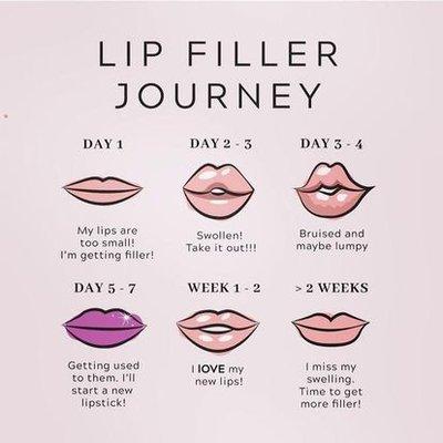 Lip fillers take time! Learn more by giving us a call.