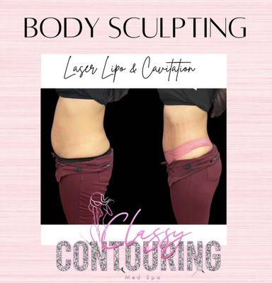 Brazilian body contouring