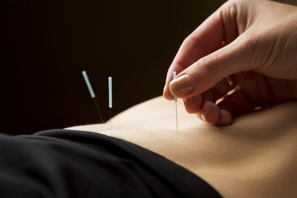 Acupuncture Fertility