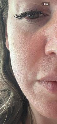 Over 3 weeks after microneedling...