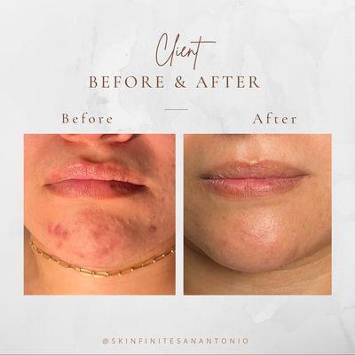 Acne Treatmenr with Peels