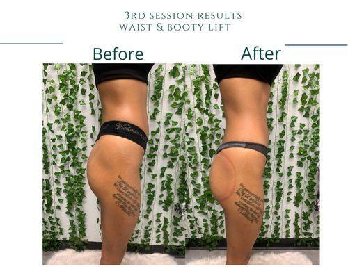 Stomach on FLAT, booty on PHAT! Hello abs!  
Slimmed her stomach and enhanced her buttocks! 3 session results!